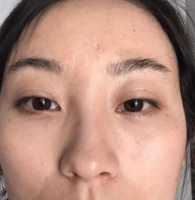 去眼袋手术