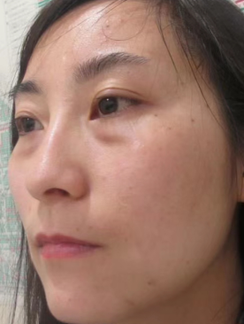 去眼袋手术