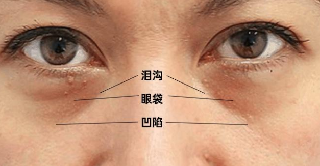 眼袋
