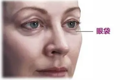 眼袋