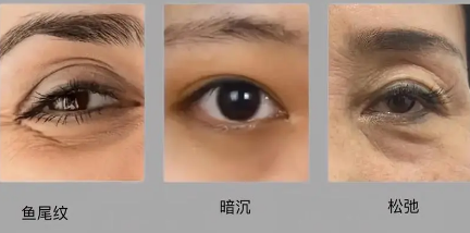 眼袋