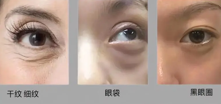 眼袋
