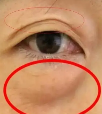 眼袋