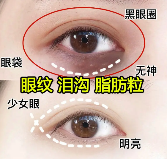 去眼袋手术