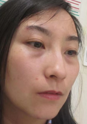 去眼袋手术