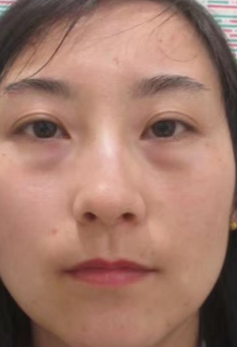去眼袋手术