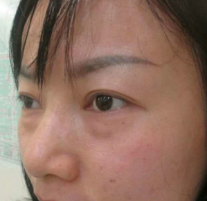 去眼袋手术