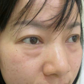 去眼袋手术