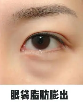 去眼袋手术