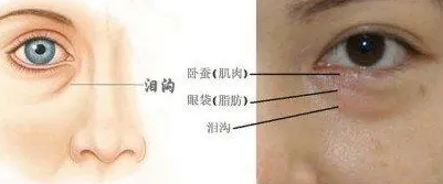 去眼袋手术