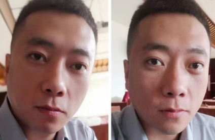 去眼袋手术