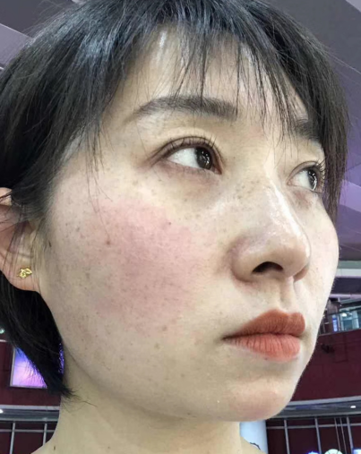 去眼袋手术