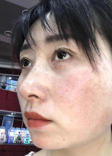 去眼袋手术