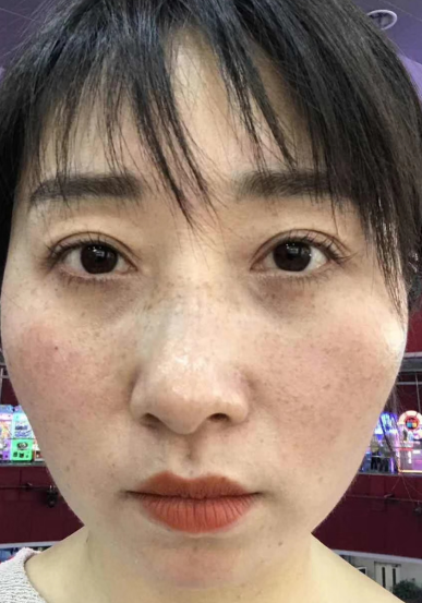 去眼袋手术