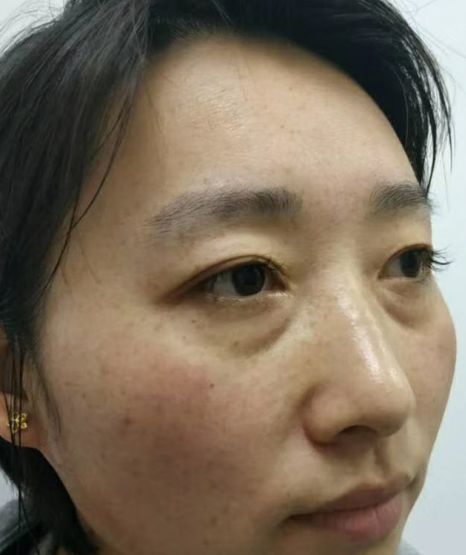 去眼袋手术