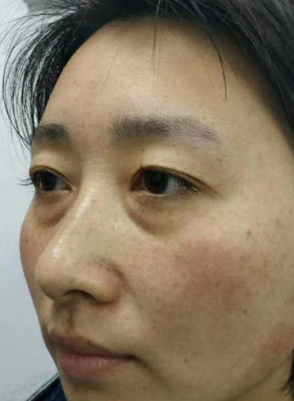 去眼袋手术