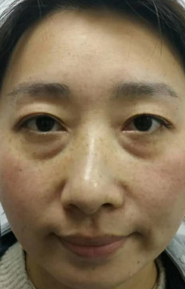 去眼袋手术