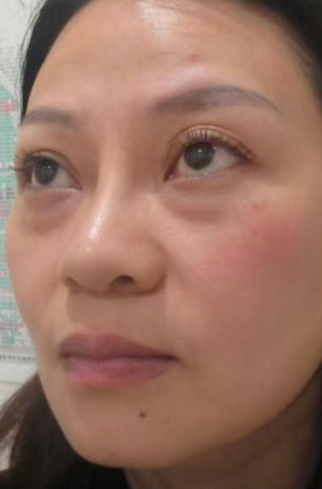 去眼袋手术
