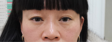 去眼袋手术