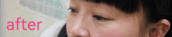 去眼袋手术