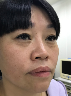 去眼袋手术