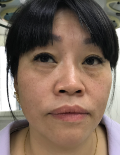 去眼袋手术