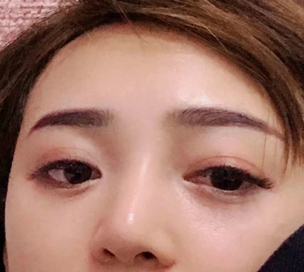 去眼袋手术
