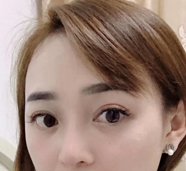 去眼袋手术