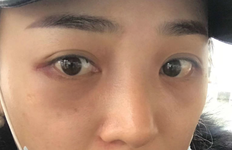 去眼袋手术