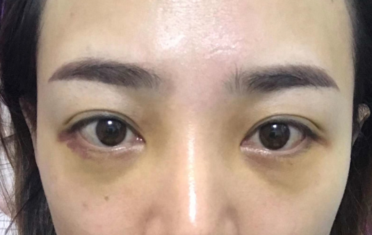 去眼袋手术