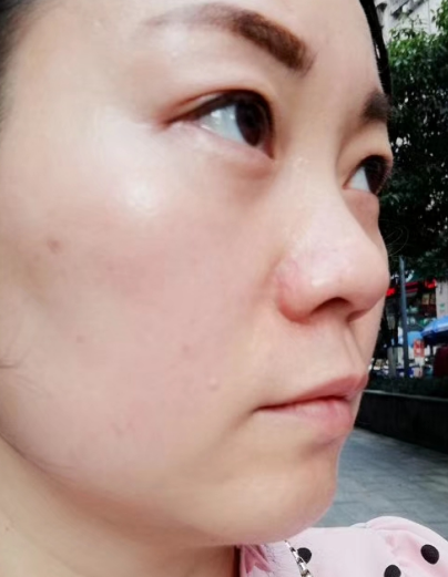 去眼袋手术