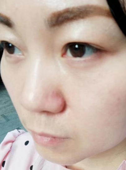 去眼袋手术