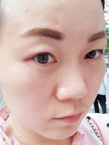 去眼袋手术