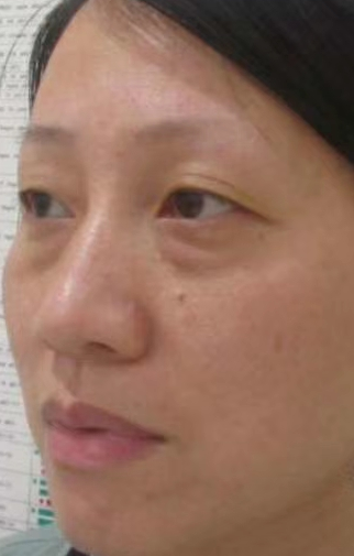 去眼袋手术