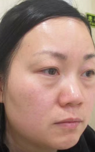 去眼袋手术