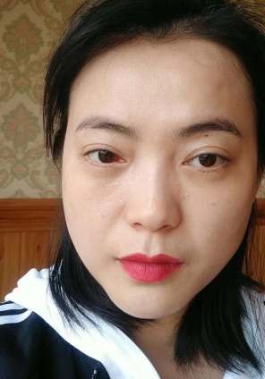 去眼袋手术