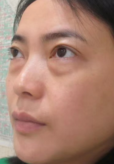 去眼袋手术