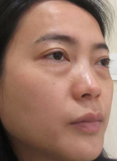 去眼袋手术