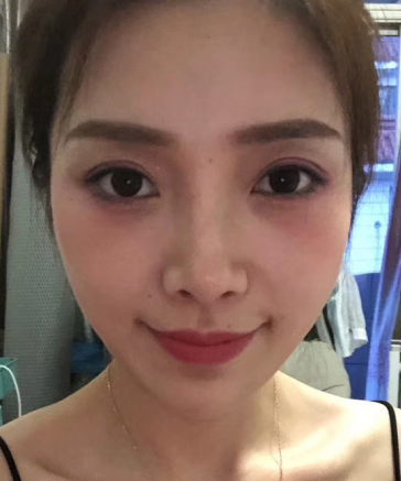 去眼袋手术