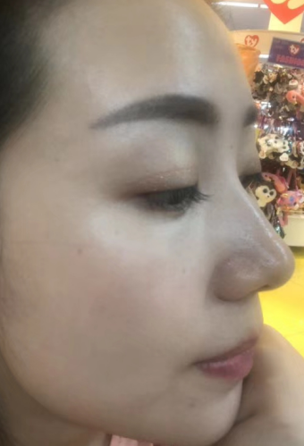 去眼袋手术