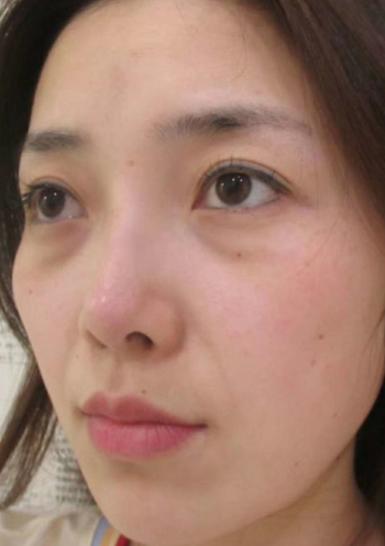 去眼袋手术