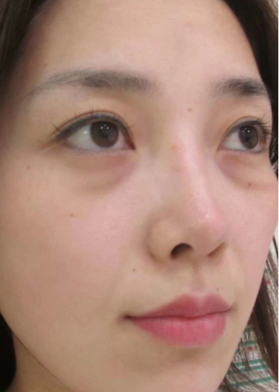 去眼袋手术