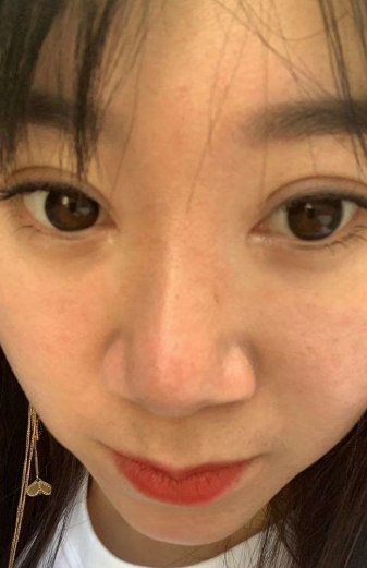 去眼袋手术