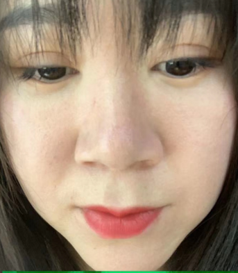 去眼袋手术