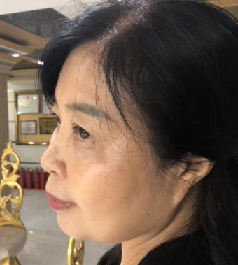 去眼袋手术