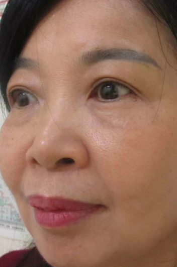 去眼袋手术