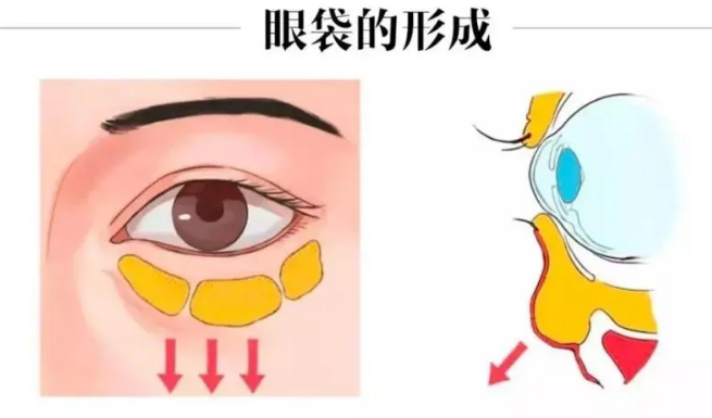 去眼袋手术