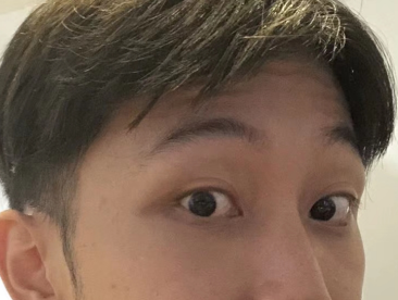 去眼袋手术