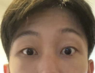 去眼袋手术