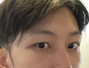 去眼袋手术